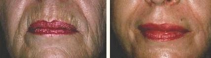 PEELING DE CRISTAL ANTES E DEPOIS PEELING DE CRISTAL   PREÇO, ANTES E DEPOIS