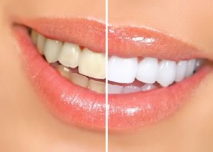 COMO CLAREAR DENTE NATURALMENTE EM CASA
