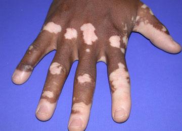O QUE É VITILIGO